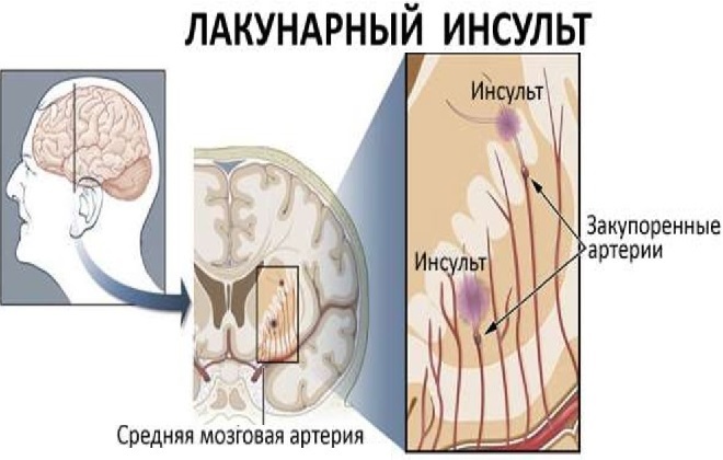Признаки лакунарного инсульта головного мозга 