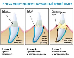 Стадии зубного налета - наглядная схема