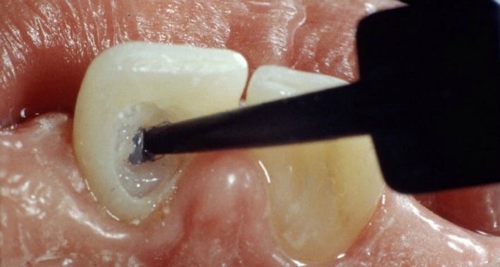 Внутриканальное отбеливание зубов 