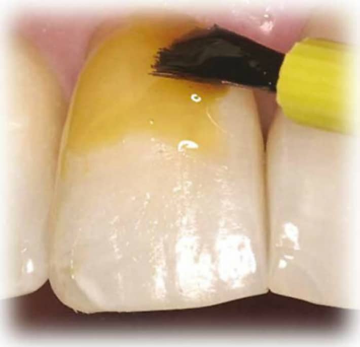 Фтор восстанавливает минеральную структуру зубной ткани