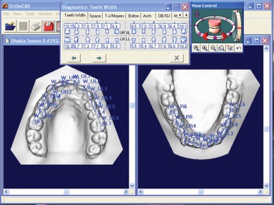 Компьютерная диагностика моделей челюстей