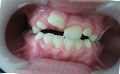Один зуб может сочетать в себе несколько патологий