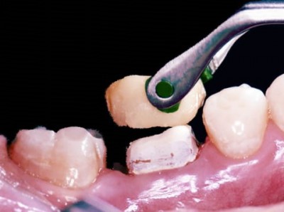 Лечение воспаления зуба под коронкой