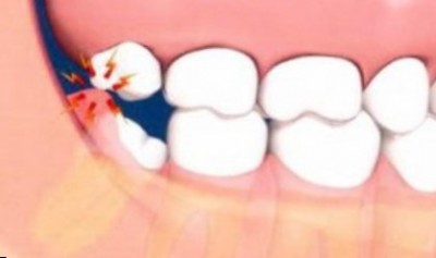 Перикоронарит у взрослых связан с прорезыванием зубов мудрости