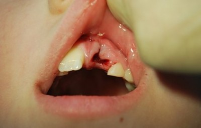 Полный вывих переднего зуба с повреждением мягких тканей десны