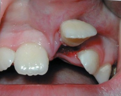 Неполный вывих зуба с наличием луночкового кровотечения