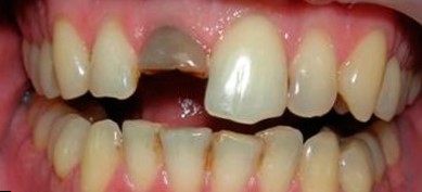 Вколоченный вывих зуба с укорочением коронковой части 