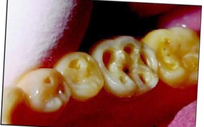 Потёртости на эмали не защищают зуб от кислого или горячего