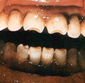Один из признаков сифилиса в полости рта
