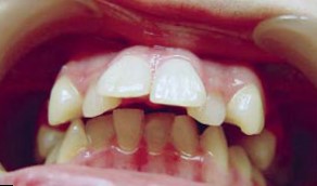 Смещение зубного ряда характерно для дистального прикуса