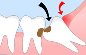 Неправильное прорезывание зуба ведёт к разнообразным осложнениям