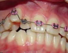 Брекеты — универсальный ортодонтический аппарат