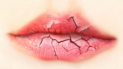 При ксеростомии сухость наблюдается не только в полости рта