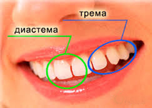 Разичные типы зазоров между зубами