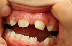 Промежутки между временными зубами могут быть естественными, физиологическими