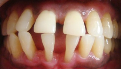 Пародонтоз и расхождение зубов — классическое сочетание двух патологий