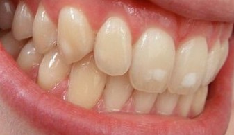 Зубы покрываются белыми пятнами