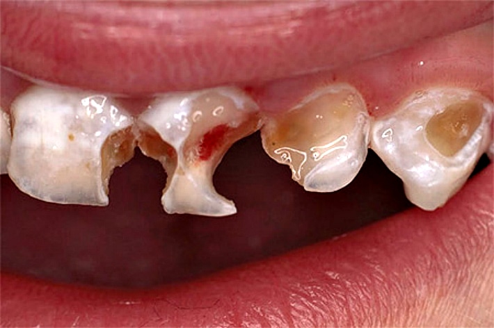 Разрушение молочных зубов