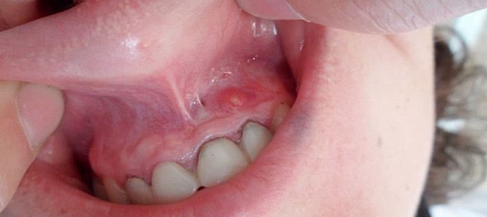 Воспаление оболочки корня зубов 