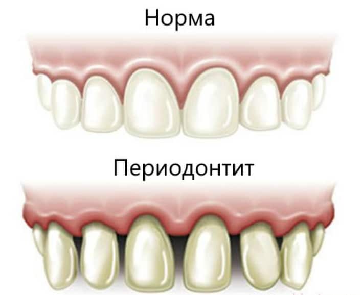 Изображение зубов при периодонтите