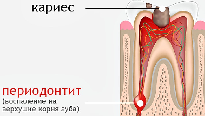Периодонтит зуба
