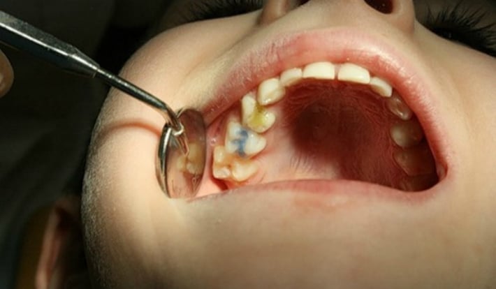 Несвоевременное лечение пульпита зуба