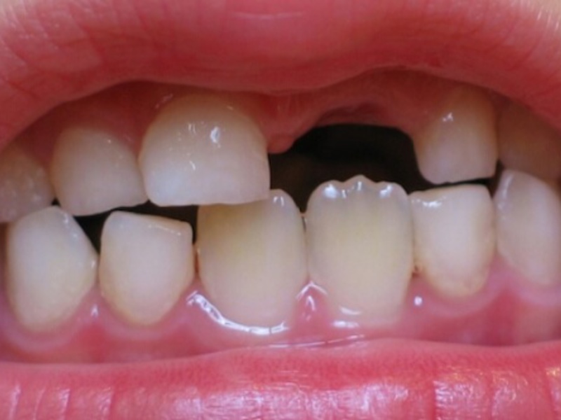 Кода происходит смена молочных зубов