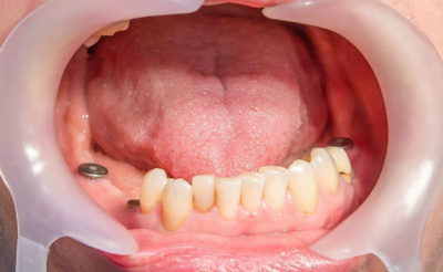 Одномоментная с удалением зуба имплантация