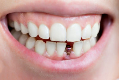 Установка импланта после удаления зуба