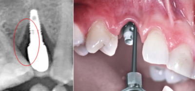 Как удаляют имплант зуба