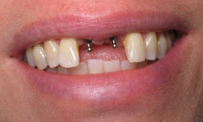 Мини-импланты зубов