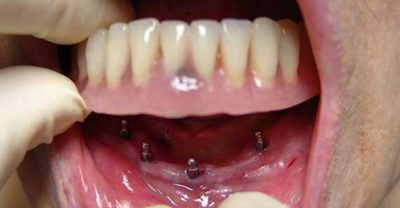 Мини-импланты зубов