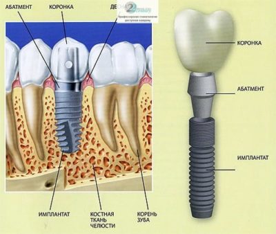 Как вставляют имплант зуба