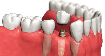Как делается имплантация зубов