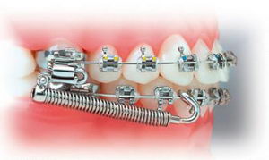 Для чего нужны ортодонтические аппараты?