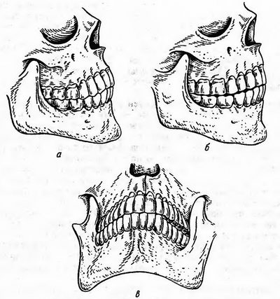 Соотношение зубных рядов в центральной, передней и боковой окклюзиях, фото