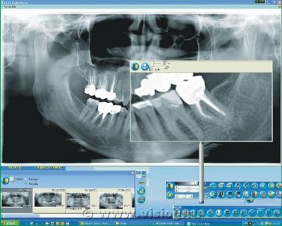 Снимок челюсти цифрового ортопантомографа
