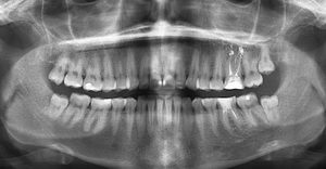 Панорамный снимок зубов: цена, преимущества ортопантомограммы, виды ортопантомографов