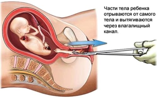 hirurg_abort-min