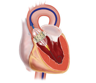 малоинвазивная замена аортального клапана