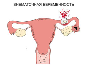 Признаки внематочной беременности на раннем сроке