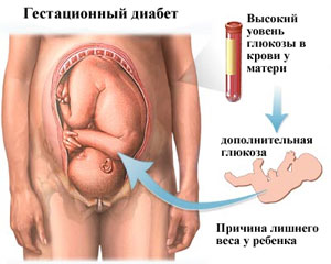 Последствия и риски гестационного диабета у беременных