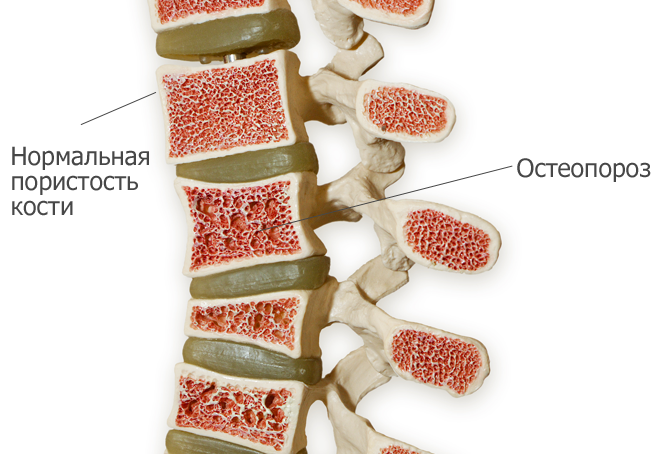 пористость кости при остеопорозе 