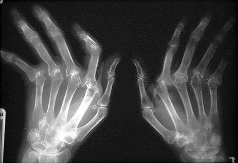 Снимок руки, суставы которой поражены артрозом