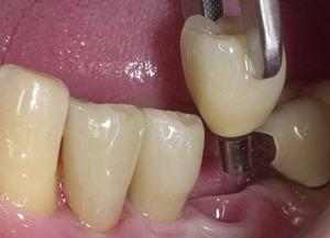 Особенности классического метода имплантации зубов