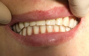 Особенности базальной имплантации зубов