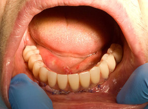Характеристики видов базальных имплантов зубов