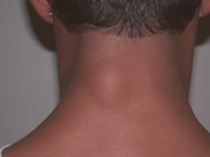 Шишка на шее под кожей: причины появления уплотнения спереди, посередине, сбоку справа и слева у взрослых