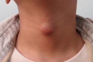 Причины, по которым могут появляться шишки на шее