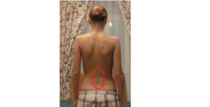 Лечение шишки на спине под кожей ниже лопатки и около позвоночника